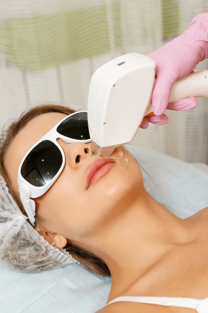 woman receiving IPL treatment on the face for acne